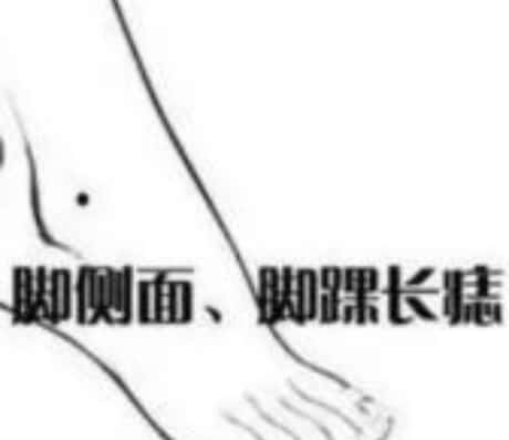 脚踝上长了痣，这是怎么回事？