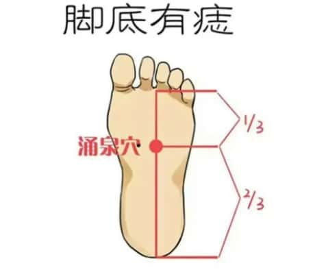 女左脚底有颗痣，探寻命运符号背后的故事