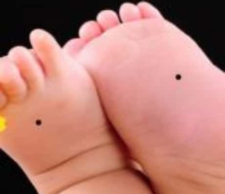 女生右脚痣的奥秘